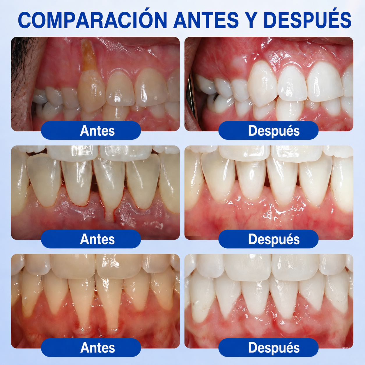☘️🇸🇰👨‍⚕️✅🦷Gel de reparación periodontal Healrize® GumRevive🦷🍋🍋
