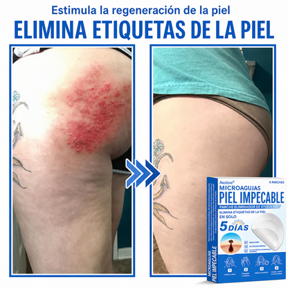 Awzlove®  𝐏𝐚𝐫𝐜𝐡𝐞𝐬 𝐡𝐢𝐝𝐫𝐨𝐜𝐨𝐥𝐨𝐢𝐝𝐞𝐬 𝐜𝐨𝐧 𝐦𝐢𝐜𝐫𝐨𝐚𝐠𝐮𝐣𝐚𝐬 𝟐 𝐞𝐧 𝟏  𝐄𝐬𝐩𝐞𝐜𝐢𝐚𝐥𝐦𝐞𝐧𝐭𝐞 𝐝𝐢𝐬𝐞ñ𝐚𝐝𝐨𝐬 𝐩𝐚𝐫𝐚 𝐞𝐥𝐢𝐦𝐢𝐧𝐚𝐫 𝐥𝐮𝐧𝐚𝐫𝐞𝐬 𝐞𝐥𝐞𝐯𝐚𝐝𝐨𝐬, 𝐚𝐜𝐧é, 𝐯𝐞𝐫𝐫𝐮𝐠𝐚𝐬 𝐩𝐥𝐚𝐧𝐚𝐬 𝐲 𝐩𝐫𝐨𝐭𝐮𝐛𝐞𝐫𝐚𝐧𝐜𝐢𝐚𝐬 𝐜𝐮𝐭á𝐧𝐞𝐚𝐬 | 𝐏𝐚𝐪𝐮𝐞𝐭𝐞 𝐝𝐞 𝟏𝟒𝟒 𝐮𝐧𝐢𝐝𝐚𝐝𝐞𝐬  🐒🐶1