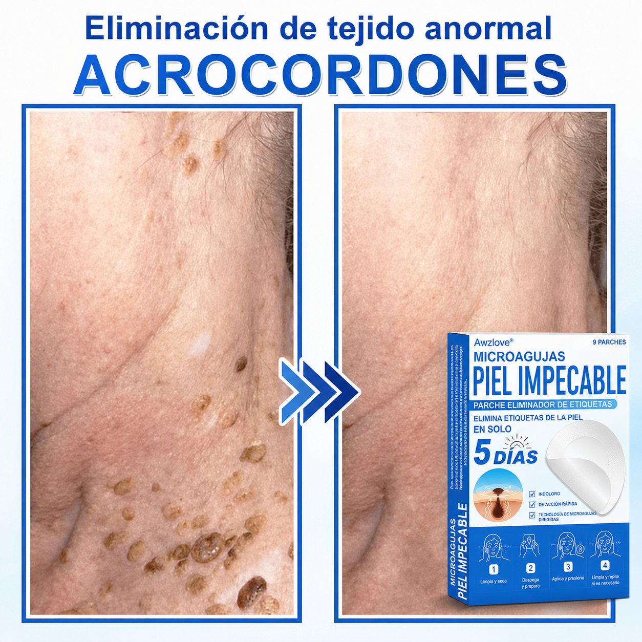 Awzlove®  𝐏𝐚𝐫𝐜𝐡𝐞𝐬 𝐡𝐢𝐝𝐫𝐨𝐜𝐨𝐥𝐨𝐢𝐝𝐞𝐬 𝐜𝐨𝐧 𝐦𝐢𝐜𝐫𝐨𝐚𝐠𝐮𝐣𝐚𝐬 𝟐 𝐞𝐧 𝟏  𝐄𝐬𝐩𝐞𝐜𝐢𝐚𝐥𝐦𝐞𝐧𝐭𝐞 𝐝𝐢𝐬𝐞ñ𝐚𝐝𝐨𝐬 𝐩𝐚𝐫𝐚 𝐞𝐥𝐢𝐦𝐢𝐧𝐚𝐫 𝐥𝐮𝐧𝐚𝐫𝐞𝐬 𝐞𝐥𝐞𝐯𝐚𝐝𝐨𝐬, 𝐚𝐜𝐧é, 𝐯𝐞𝐫𝐫𝐮𝐠𝐚𝐬 𝐩𝐥𝐚𝐧𝐚𝐬 𝐲 𝐩𝐫𝐨𝐭𝐮𝐛𝐞𝐫𝐚𝐧𝐜𝐢𝐚𝐬 𝐜𝐮𝐭á𝐧𝐞𝐚𝐬 | 𝐏𝐚𝐪𝐮𝐞𝐭𝐞 𝐝𝐞 𝟏𝟒𝟒 𝐮𝐧𝐢𝐝𝐚𝐝𝐞𝐬  🐒🐶1