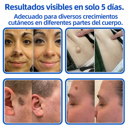 Awzlove®  𝐏𝐚𝐫𝐜𝐡𝐞𝐬 𝐡𝐢𝐝𝐫𝐨𝐜𝐨𝐥𝐨𝐢𝐝𝐞𝐬 𝐜𝐨𝐧 𝐦𝐢𝐜𝐫𝐨𝐚𝐠𝐮𝐣𝐚𝐬 𝟐 𝐞𝐧 𝟏  𝐄𝐬𝐩𝐞𝐜𝐢𝐚𝐥𝐦𝐞𝐧𝐭𝐞 𝐝𝐢𝐬𝐞ñ𝐚𝐝𝐨𝐬 𝐩𝐚𝐫𝐚 𝐞𝐥𝐢𝐦𝐢𝐧𝐚𝐫 𝐥𝐮𝐧𝐚𝐫𝐞𝐬 𝐞𝐥𝐞𝐯𝐚𝐝𝐨𝐬, 𝐚𝐜𝐧é, 𝐯𝐞𝐫𝐫𝐮𝐠𝐚𝐬 𝐩𝐥𝐚𝐧𝐚𝐬 𝐲 𝐩𝐫𝐨𝐭𝐮𝐛𝐞𝐫𝐚𝐧𝐜𝐢𝐚𝐬 𝐜𝐮𝐭á𝐧𝐞𝐚𝐬 | 𝐏𝐚𝐪𝐮𝐞𝐭𝐞 𝐝𝐞 𝟏𝟒𝟒 𝐮𝐧𝐢𝐝𝐚𝐝𝐞𝐬  🐒🐶1