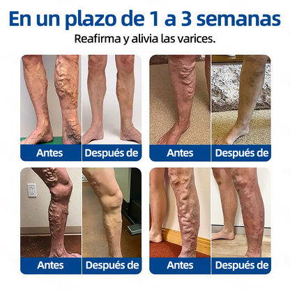 𝗛𝗲𝗮𝗹𝗿𝗶𝘇𝗲® 𝗣𝗮𝗿𝗰𝗵𝗲 𝗠𝗶𝗰𝗿𝗼𝗻𝗲𝗲𝗱𝗹𝗲 𝗩𝗲𝗶𝗻𝗧𝗮𝗿𝗴𝗲𝘁 𝗔𝗹𝗶𝘃𝗶𝗼 𝗜𝗻𝘀𝘁𝗮𝗻𝘁𝗮́𝗻𝗲𝗼, 𝗥𝗲𝘀𝘂𝗹𝘁𝗮𝗱𝗼𝘀 𝗮 𝗟𝗮𝗿𝗴𝗼 𝗣𝗹𝗮𝘇𝗼🏃‍♂️‍➡️🏃‍♂️‍➡️1