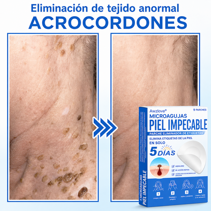 Awzlove®  𝐏𝐚𝐫𝐜𝐡𝐞𝐬 𝐡𝐢𝐝𝐫𝐨𝐜𝐨𝐥𝐨𝐢𝐝𝐞𝐬 𝐜𝐨𝐧 𝐦𝐢𝐜𝐫𝐨𝐚𝐠𝐮𝐣𝐚𝐬 𝟐 𝐞𝐧 𝟏  𝐄𝐬𝐩𝐞𝐜𝐢𝐚𝐥𝐦𝐞𝐧𝐭𝐞 𝐝𝐢𝐬𝐞ñ𝐚𝐝𝐨𝐬 𝐩𝐚𝐫𝐚 𝐞𝐥𝐢𝐦𝐢𝐧𝐚𝐫 𝐥𝐮𝐧𝐚𝐫𝐞𝐬 𝐞𝐥𝐞𝐯𝐚𝐝𝐨𝐬, 𝐚𝐜𝐧é, 𝐯𝐞𝐫𝐫𝐮𝐠𝐚𝐬 𝐩𝐥𝐚𝐧𝐚𝐬 𝐲 𝐩𝐫𝐨𝐭𝐮𝐛𝐞𝐫𝐚𝐧𝐜𝐢𝐚𝐬 𝐜𝐮𝐭á𝐧𝐞𝐚𝐬 | 𝐏𝐚𝐪𝐮𝐞𝐭𝐞 𝐝𝐞 𝟏𝟒𝟒 𝐮𝐧𝐢𝐝𝐚𝐝𝐞𝐬  🐒🐶1
