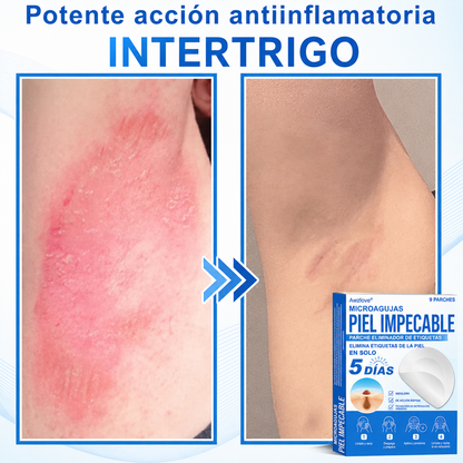 Awzlove®  𝐏𝐚𝐫𝐜𝐡𝐞𝐬 𝐡𝐢𝐝𝐫𝐨𝐜𝐨𝐥𝐨𝐢𝐝𝐞𝐬 𝐜𝐨𝐧 𝐦𝐢𝐜𝐫𝐨𝐚𝐠𝐮𝐣𝐚𝐬 𝟐 𝐞𝐧 𝟏  𝐄𝐬𝐩𝐞𝐜𝐢𝐚𝐥𝐦𝐞𝐧𝐭𝐞 𝐝𝐢𝐬𝐞ñ𝐚𝐝𝐨𝐬 𝐩𝐚𝐫𝐚 𝐞𝐥𝐢𝐦𝐢𝐧𝐚𝐫 𝐥𝐮𝐧𝐚𝐫𝐞𝐬 𝐞𝐥𝐞𝐯𝐚𝐝𝐨𝐬, 𝐚𝐜𝐧é, 𝐯𝐞𝐫𝐫𝐮𝐠𝐚𝐬 𝐩𝐥𝐚𝐧𝐚𝐬 𝐲 𝐩𝐫𝐨𝐭𝐮𝐛𝐞𝐫𝐚𝐧𝐜𝐢𝐚𝐬 𝐜𝐮𝐭á𝐧𝐞𝐚𝐬 | 𝐏𝐚𝐪𝐮𝐞𝐭𝐞 𝐝𝐞 𝟏𝟒𝟒 𝐮𝐧𝐢𝐝𝐚𝐝𝐞𝐬  🐒🐶1